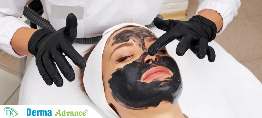 Image of Carbon Laser Peel treatment being performed on a patient, showing a clear and smooth skin result.