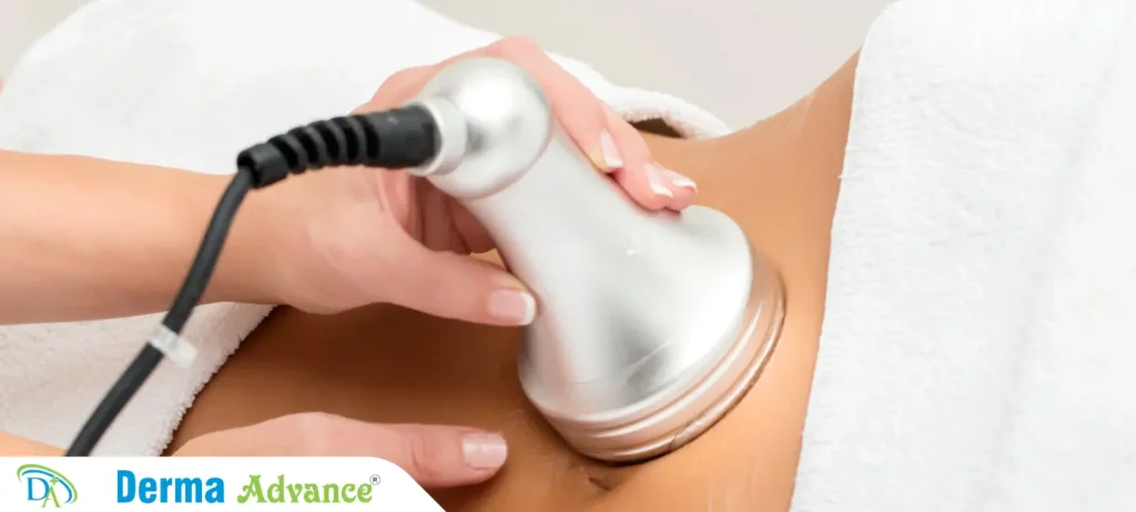 Image of a Cavitation treatment being performed on a patient's abdomen, showing the ultrasonic device applied for fat reduction.