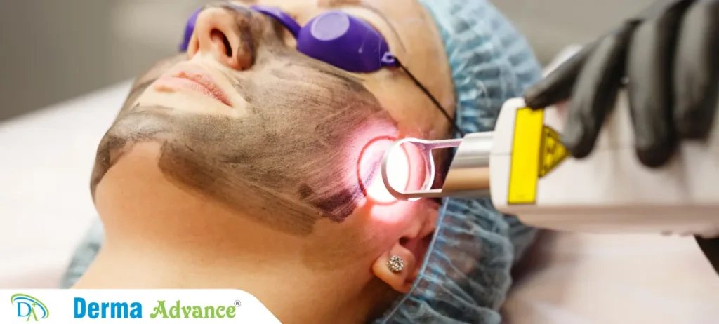 Image of CO2 Laser treatment being performed on a patient’s face for rejuvenation and scar reduction.