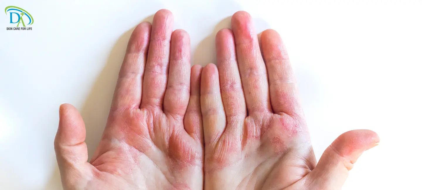 eczema-on-hands