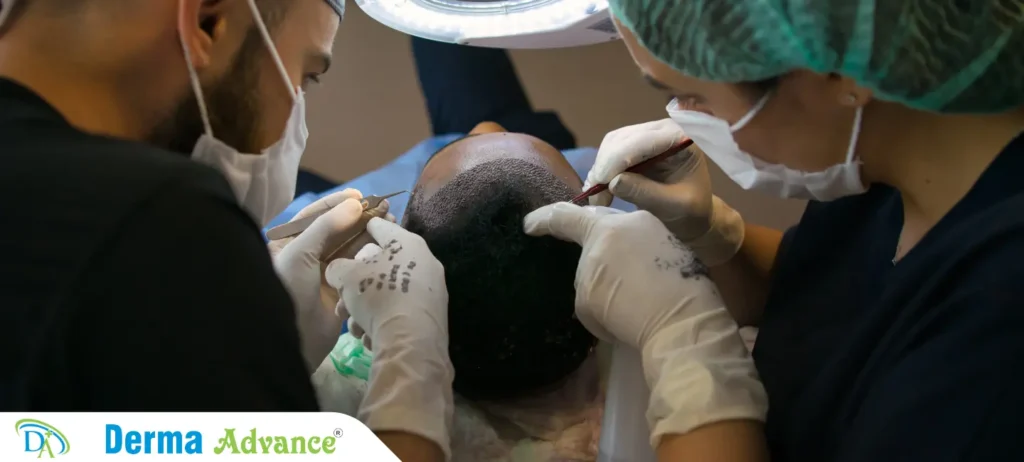 Image of a Hair Transplantation session, showcasing the procedure to restore hair growth and improve hair density, boosting self-esteem.