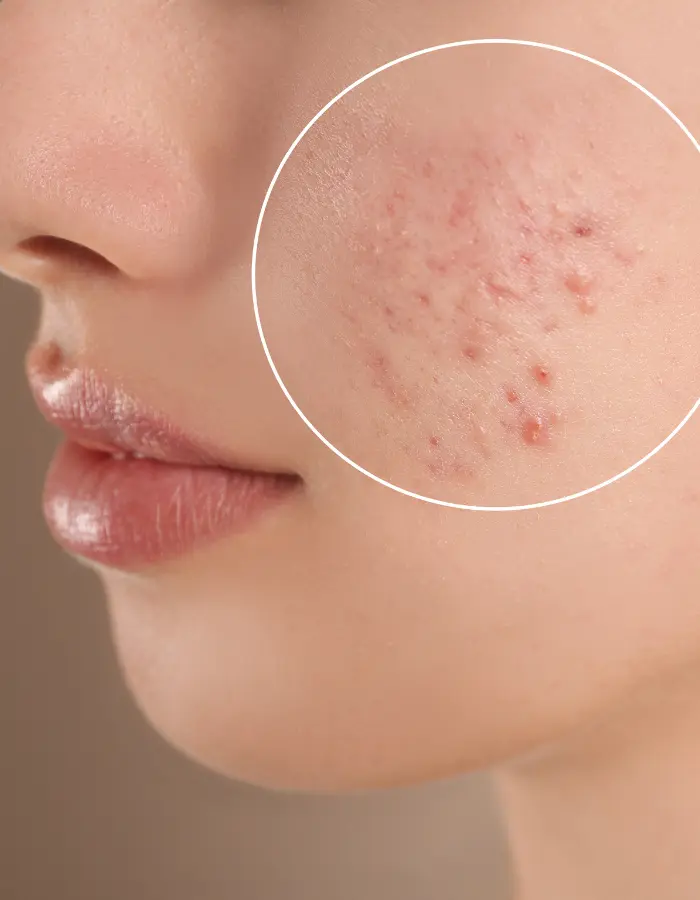 Image of a cheek with acne, it can be prevented through effective skincare and lifestyle choices.