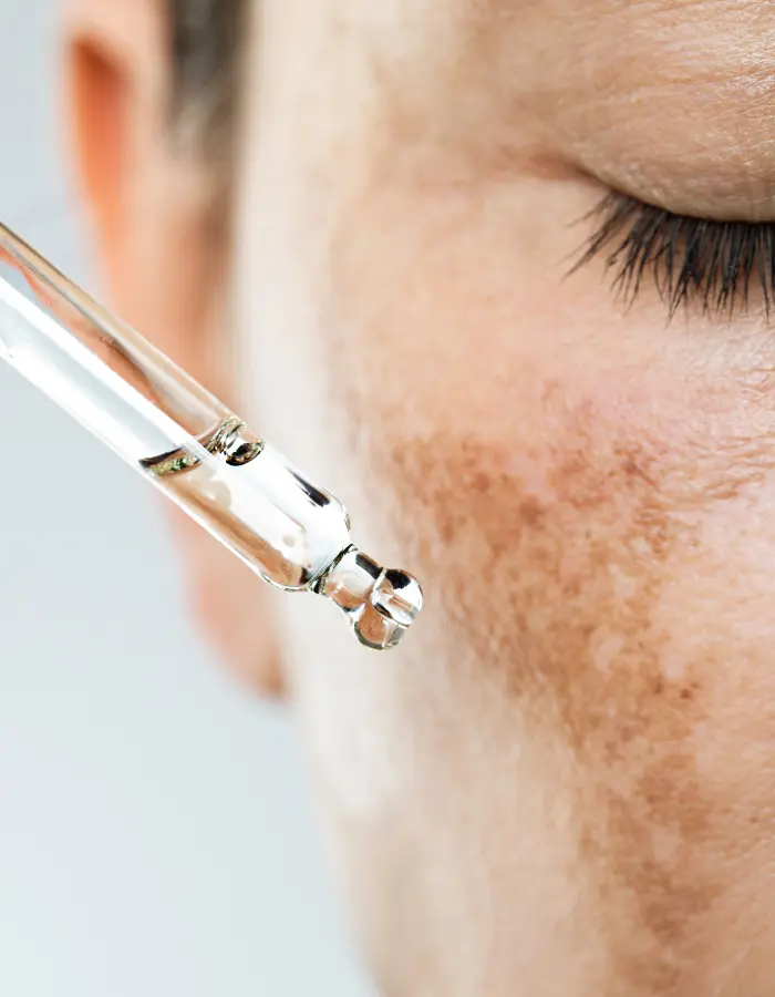 A lady using ointments to prevent hyperpigmentation from spreading on her face.