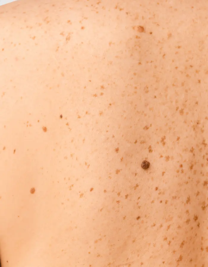 Close-up of many small moles on a person's skin, showing its typical round shape and brown color.