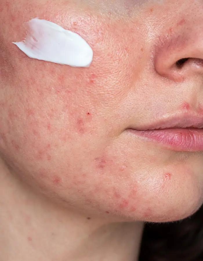 image showing how to prevent rosacea.