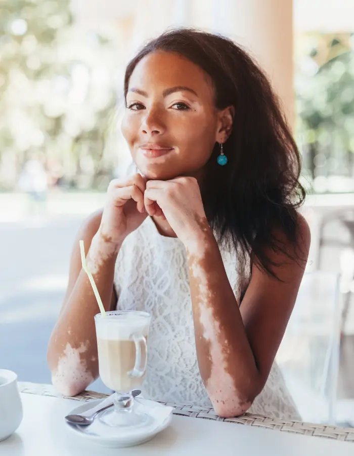 Girl with vitiligo living a normal life by protecting her skin from sunlight.