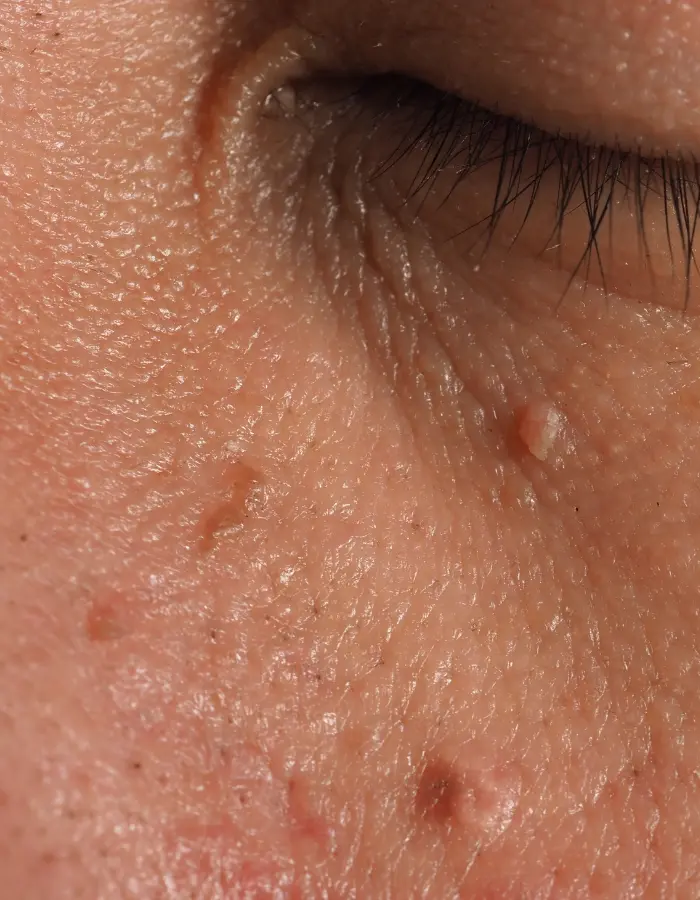 Close-up of a wart below a person's eye, showing its rough, raised texture and irregular shape.