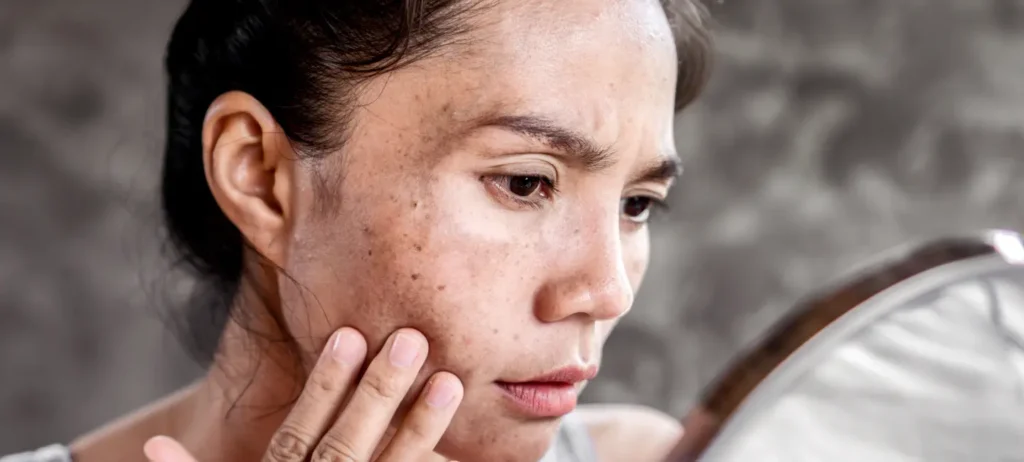 A lady suffering with hyperpigmentation on her face. She is looking at her affected skin using a mirror.