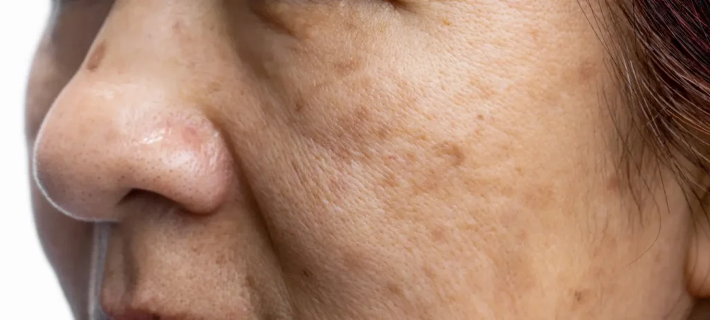 An old lady suffering with Melasma on her face.