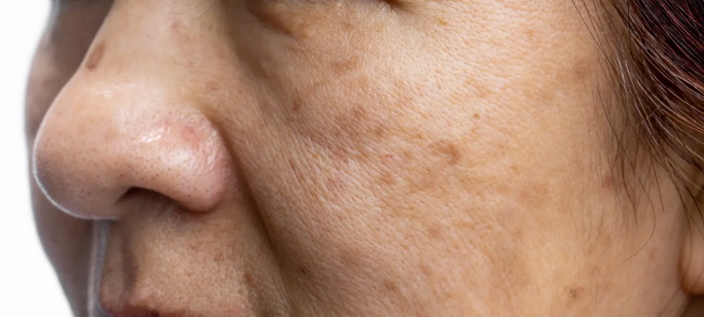 An old lady suffering with Melasma on her face.