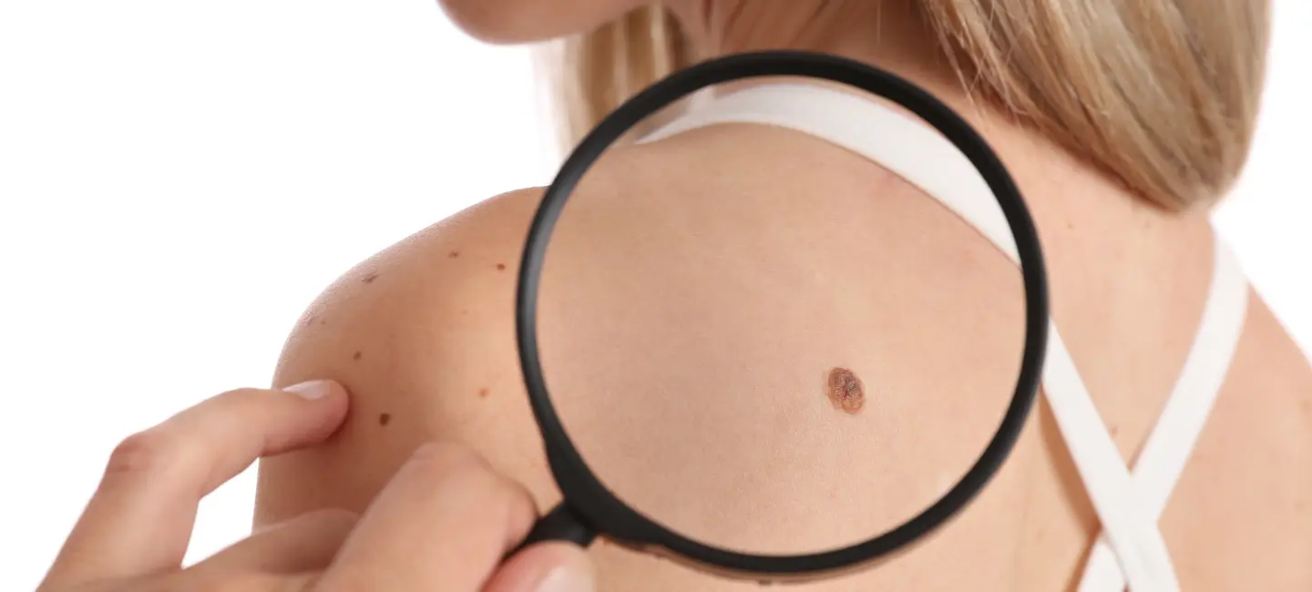 Close-up of a small, benign skin tag on the back of the shoulder of a girl.