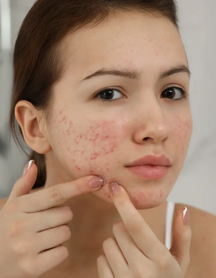 Acne treatment at Derma Advance showing acne on face of a girl.