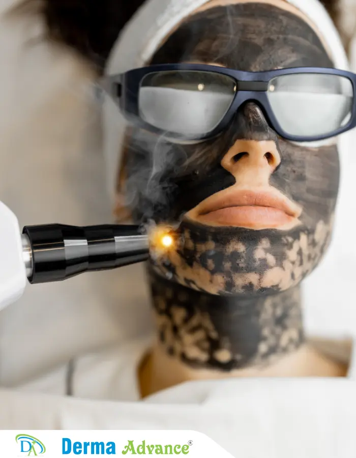 A close-up of a patient undergoing Carbon Laser Peel, showing the application of carbon lotion and laser treatment for skin rejuvenation.