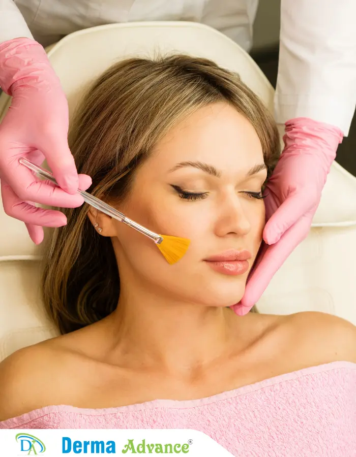 A close-up image of Chemical Peel application, showing the peeling solution being applied to the skin for exfoliation and rejuvenation.