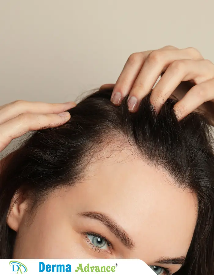 A girl suffering with hair thinning, she is looking at her receded hair-line caused due to hair thinning.