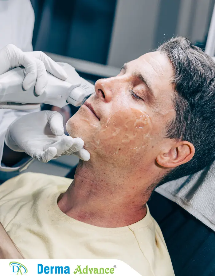 Close-up image of a HIFU device being used on a patient's face, demonstrating the application of ultrasound energy for non-surgical skin tightening.