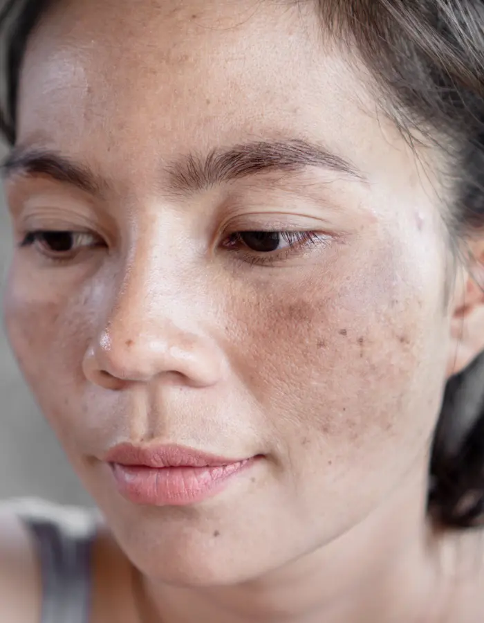 Dark skin patches from hyperpigmentation can be treated at Derma Advance.