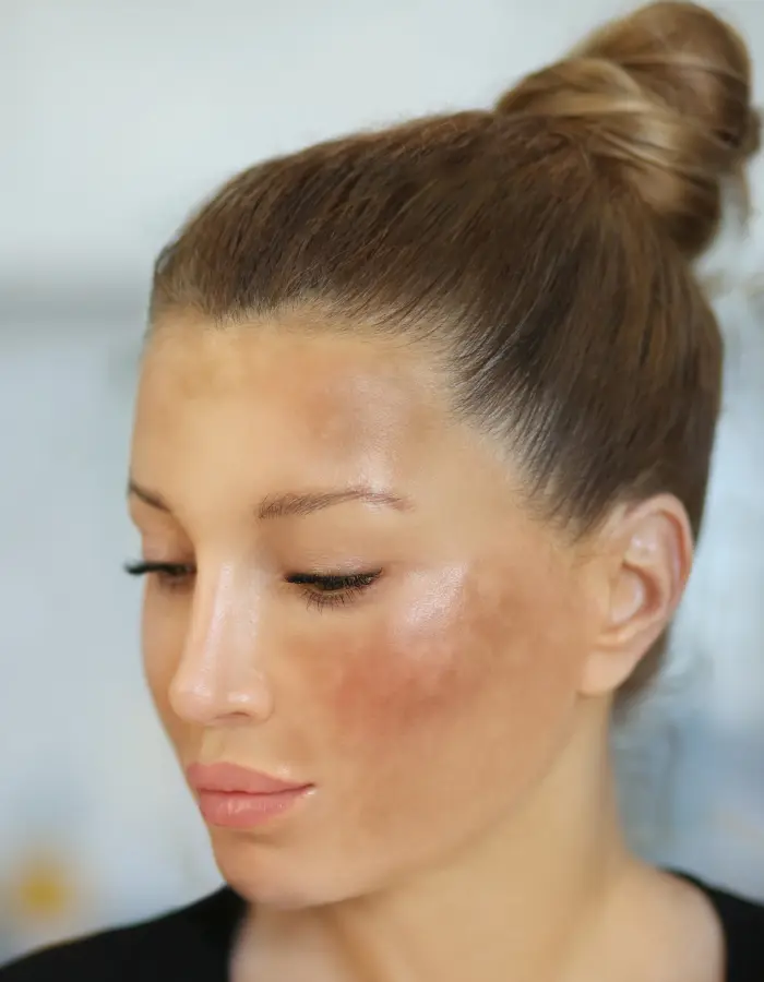 Image of a girl having Melasma skin condition on her face and cheeks.