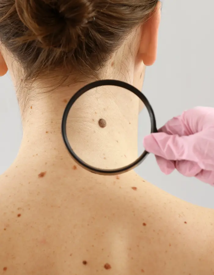 Close-up of many small moles on a lady's neck, showing its typical round shape and brown color.