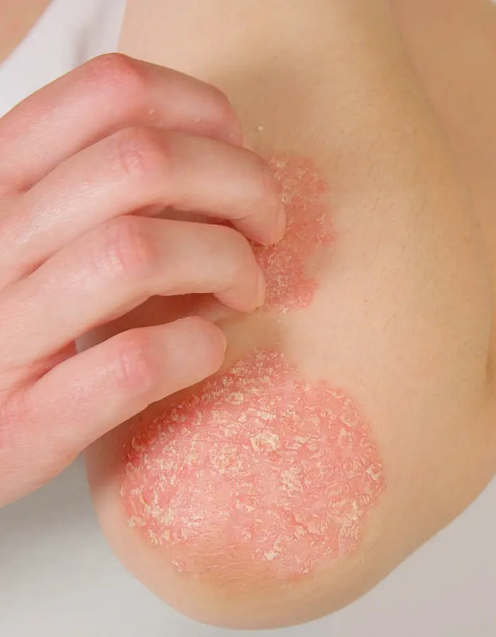 Psoriasis skin condition treatment at Derma Advance.