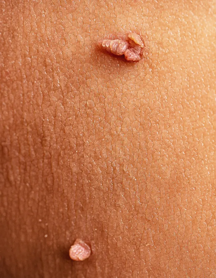 Zoomed-in picture of a skin tag on the skin a human being.