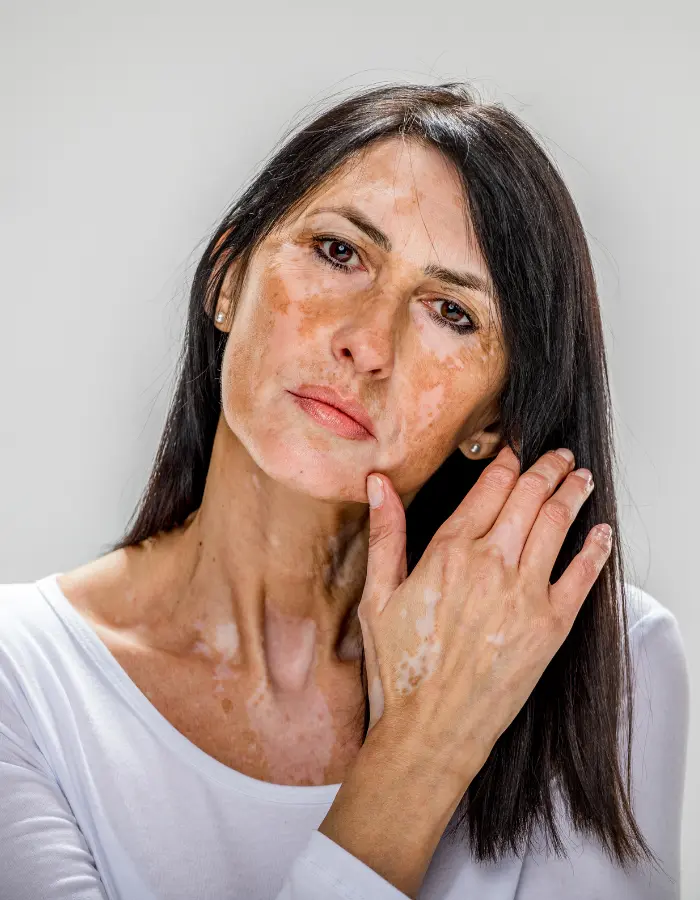 Patches on the skin of a lady in her 40s caused by vitiligo.