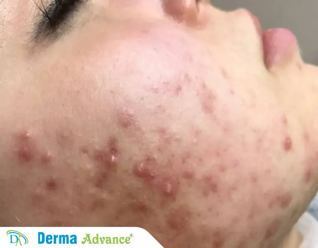 An image showing the Comedonal Acne.