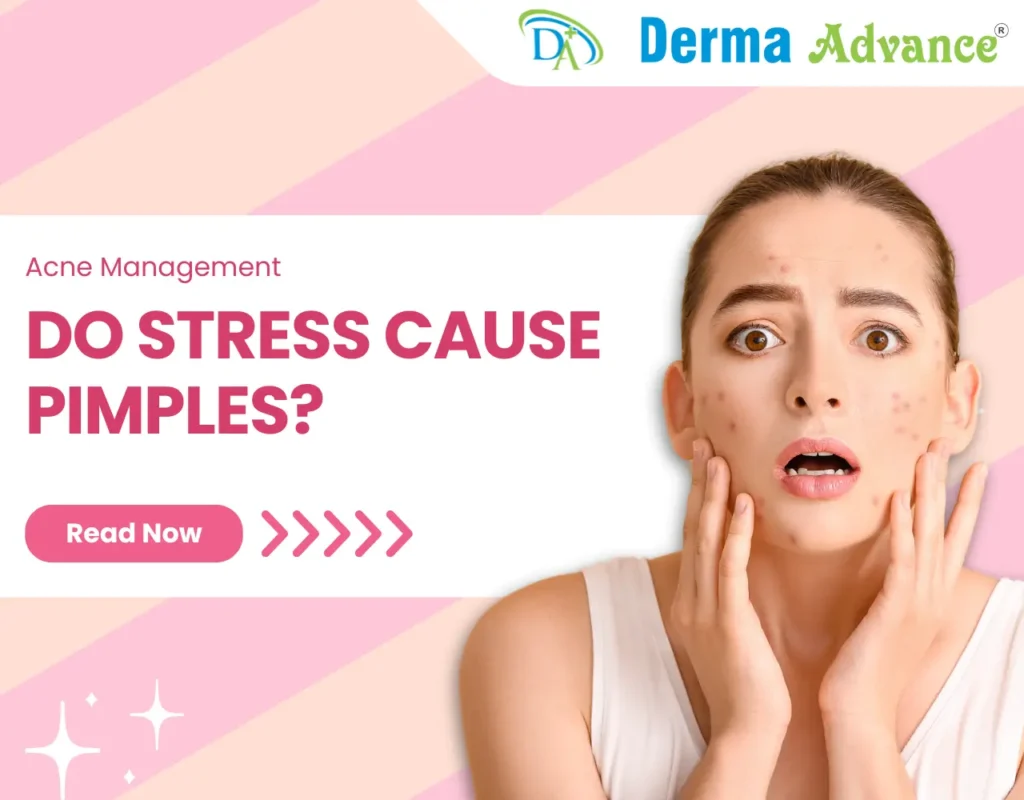 Featured Image of blog on Do Stress Cause Pimples.