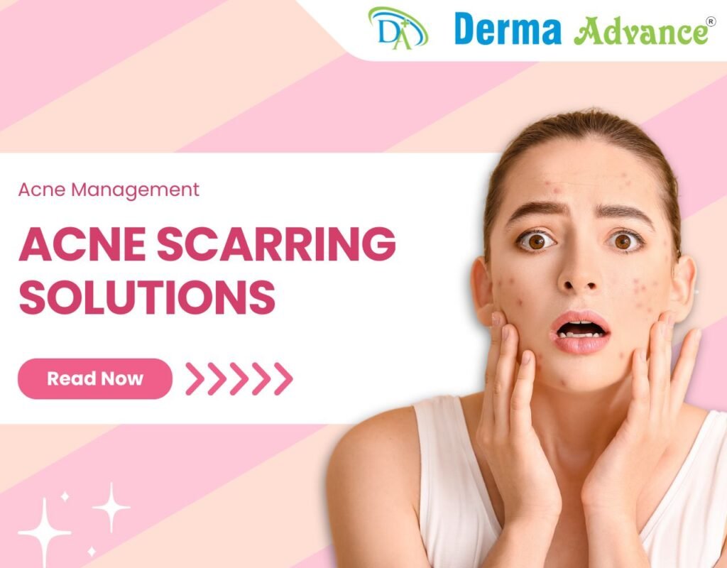 Featured Image of the blog titled Acne Scarring Solutions