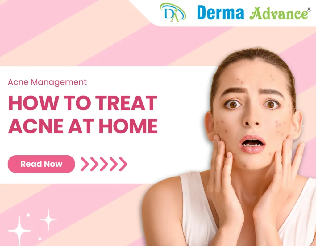 Featured Image of the blog titled How to Treat Acne at Home.