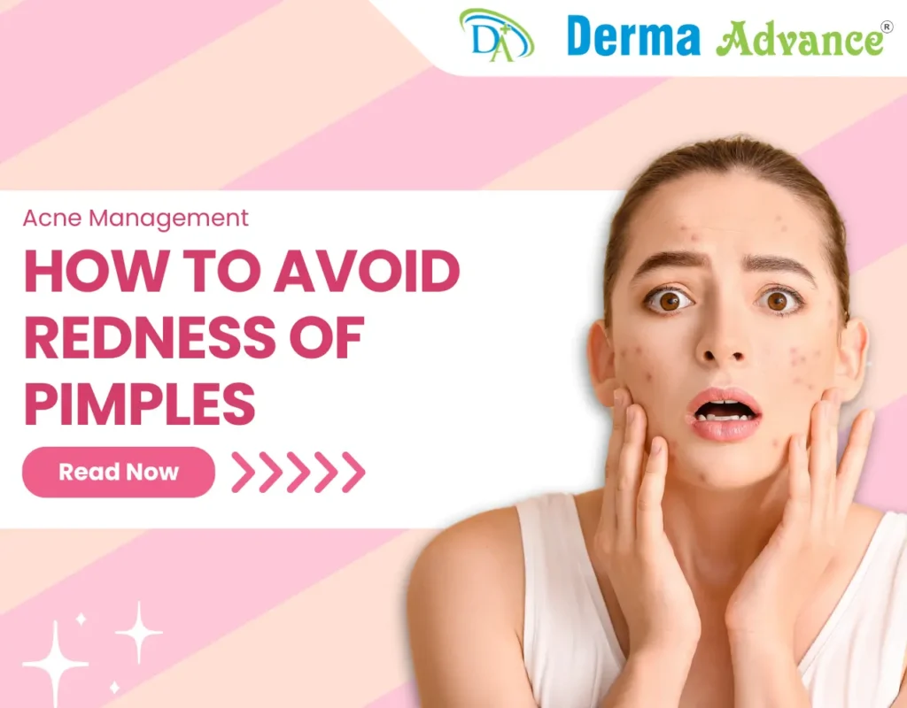 Featured image of how to avoid redness of pimples.