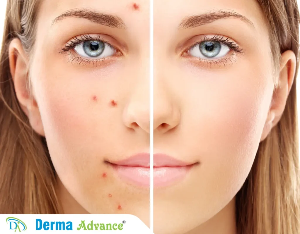 Image of a girl which has two sides where one had red acne and the other is clean.