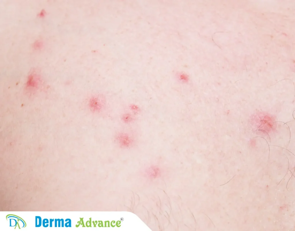 Image of red pimples on skin.