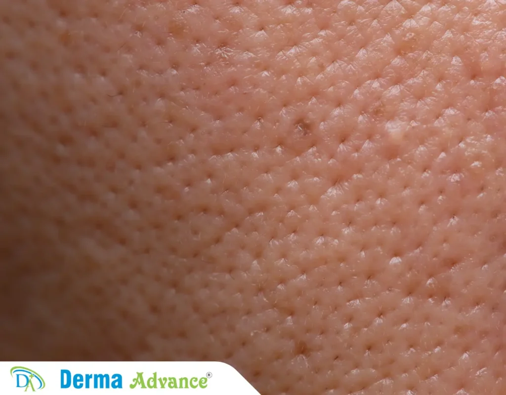 An Image showing a close up image of skin pores and how to clean skin pores to prevent acne.