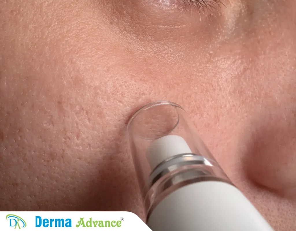 Close-up of a Hydrafacial tool applying serum to the skin during treatment, highlighting its advanced cleansing technology.