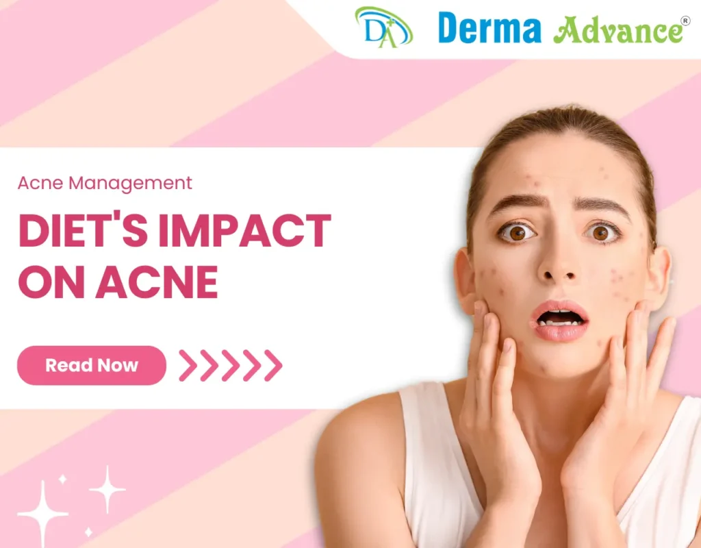 Featured image of Diet's impact on Acne.