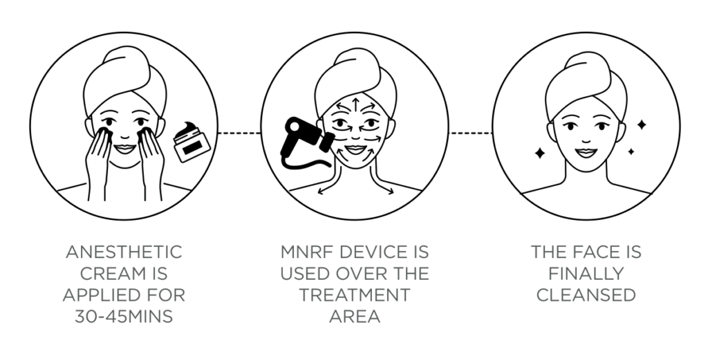 Three-step MNRF treatment process: 1) Application of anesthetic cream for 35-40 minutes, 2) Use of MNRF device for skin treatment, 3) Final cleansing of the face post-treatment.