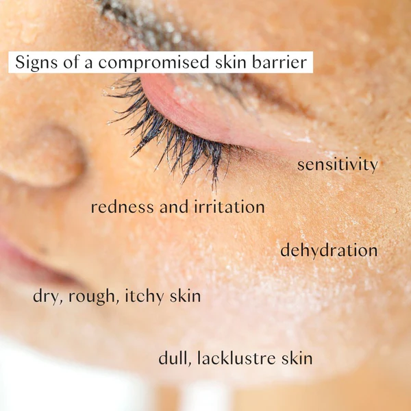 Illustration depicting signs of a compromised skin barrier: redness, dryness, flakiness, irritation, sensitivity, and potential breakouts.