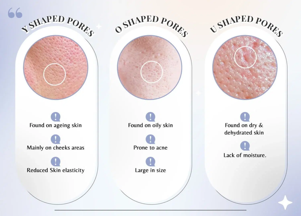 Close-up image showing different types of  open pores on face, including Y-shaped, O-shaped, and U-shaped pores, highlighting various pore shapes that can appear due to skin type and conditions.