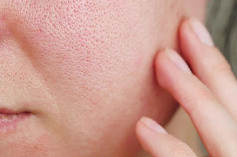 Close-up of open pores on the face highlighting common skin concern.