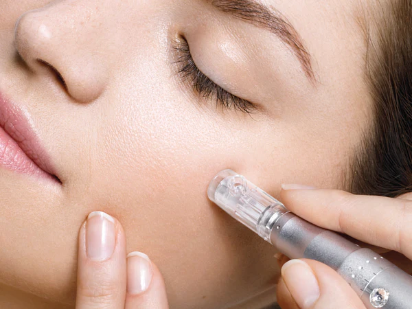 Close-up image of micro needling in progress, with a device applying tiny needles to the skin to stimulate collagen production and improve skin texture