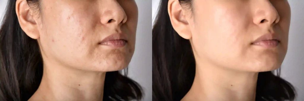 Before and after image showing the noticeable improvement in skin texture following MNRF treatment.