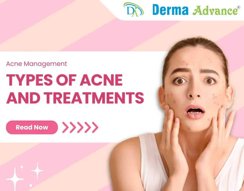 Featured Image of the blog titled Types of Acne and their Treatments.