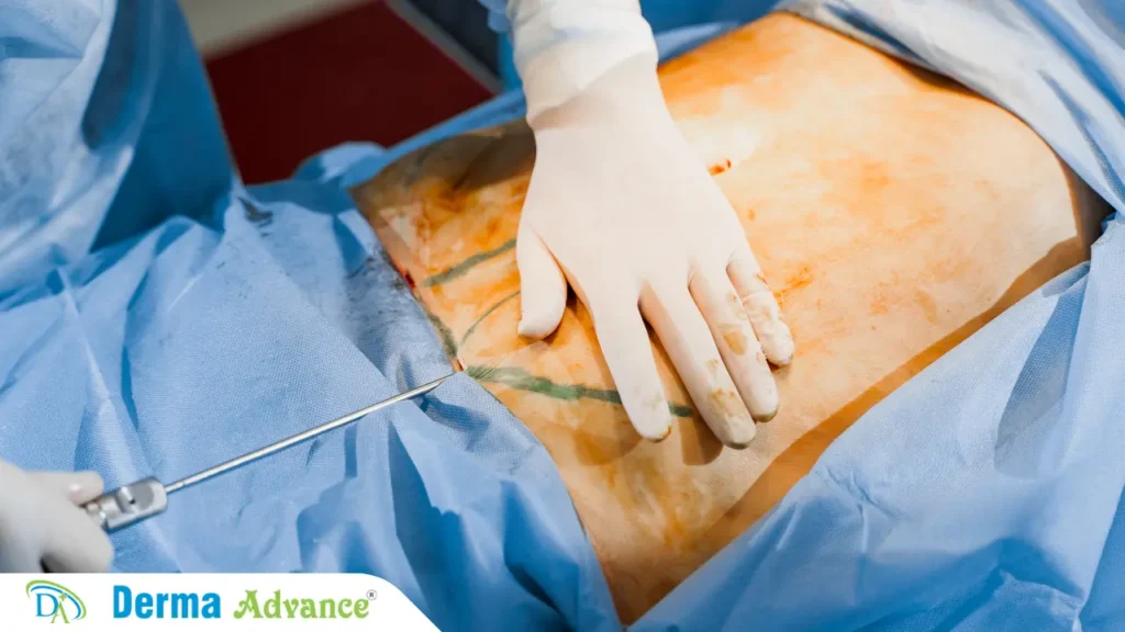 Abdominoplasty Cosmetic Surgery in Lucknow.