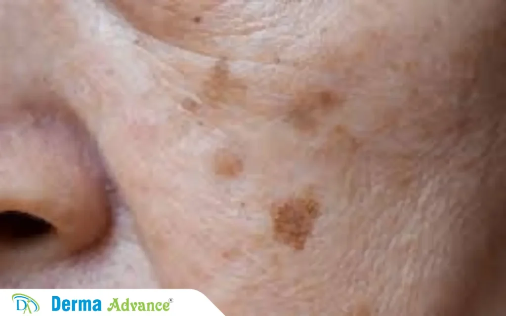 Image of a girl with Liver Spots (Solar Lentigines) on her face.