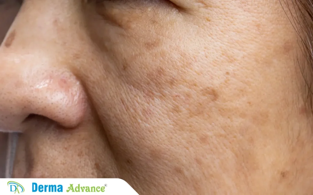 Image of a lady with melasma on her face.