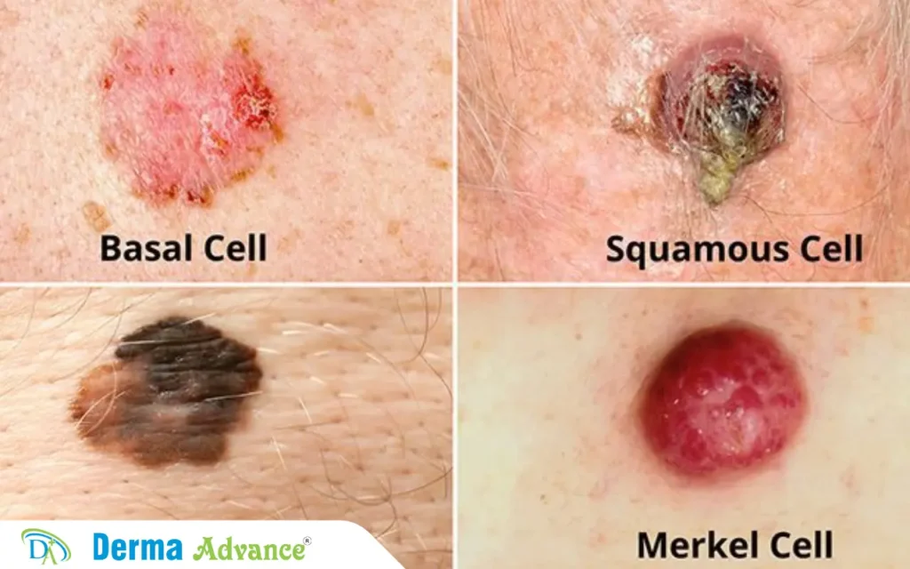 Image showcasing different types of skin cancers (Melanoma, Basal Cell, Squamous Cell Carcinoma)