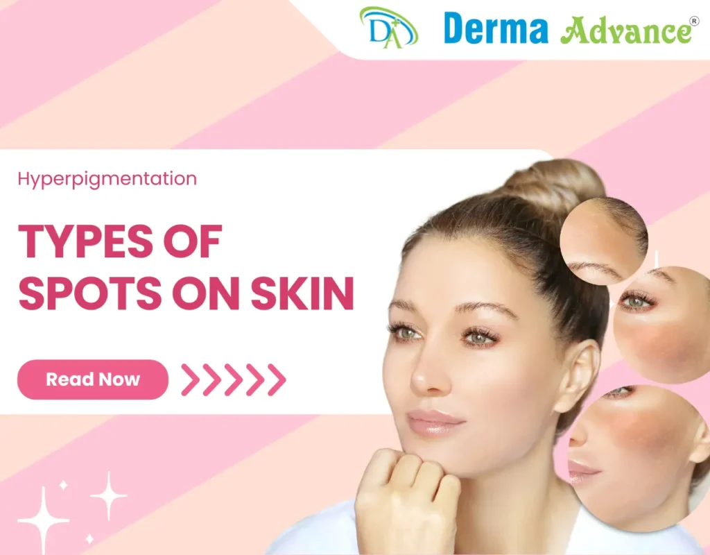 Featured Image of Types of Spots on skin.