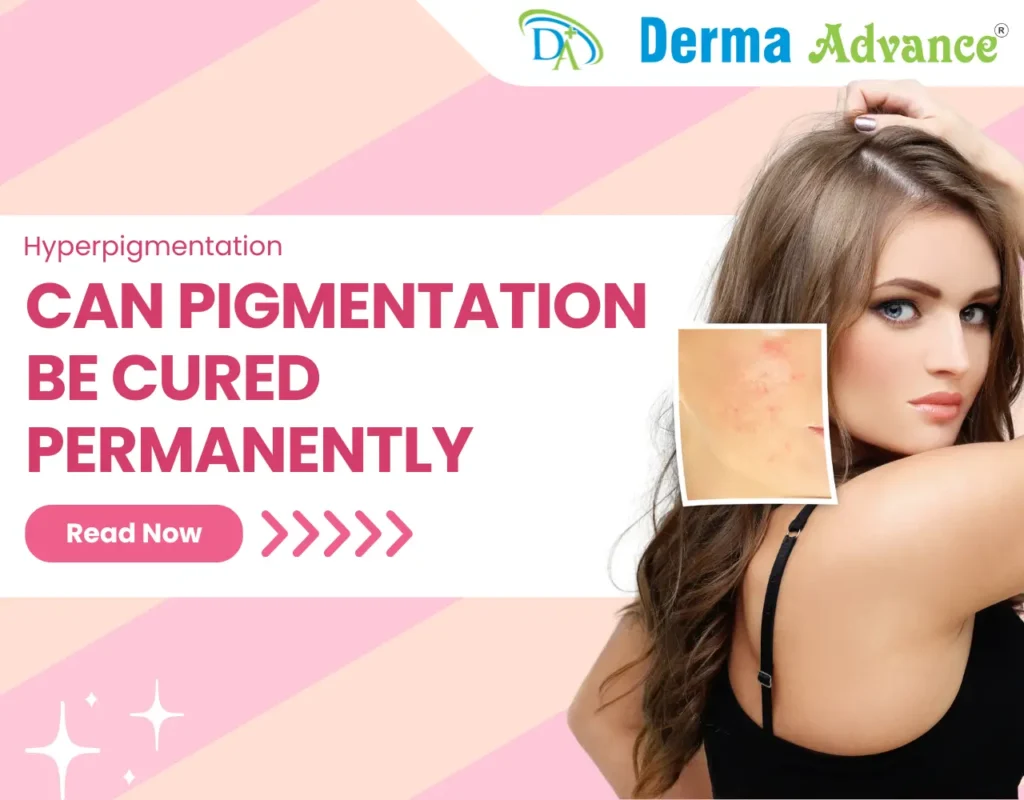 featured image of can pigmentation be cured permanently.