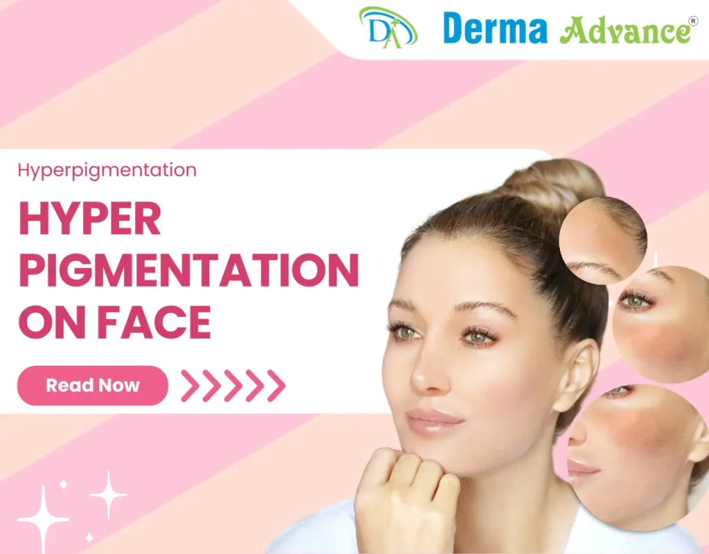 Featured Image of Hyperpigmentation on face